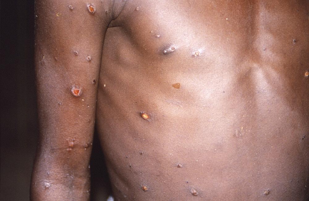 african-scientists-baffled-by-monkeypox-cases-in-europe,-us